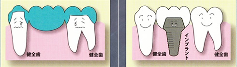 歯が中間で1本抜けた場合