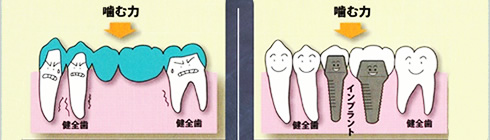 歯が中間で2本抜けた場合